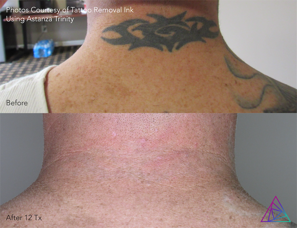 Before and after tattoo removal